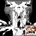 right parotid tumor CT coronal 1.jpg