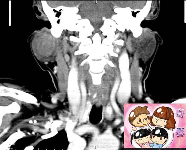 right parotid tumor CT coronal 2.jpg