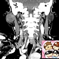 right parotid tumor CT coronal 3.jpg