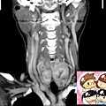 thyroid tumors CT cor 5.jpg