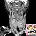 thyroid tumors CT cor 4.jpg