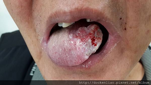 left tongue cancer 左側舌癌