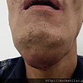 Cancer of the floor of mouth 口腔底癌