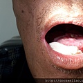 Cancer of the floor of mouth 口腔底癌