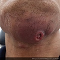 Cancer of the floor of mouth 口腔底癌