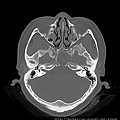 pituitary gland tumor CT axi1.jpg