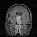 pituitary gland tumor MRI cor1.jpg