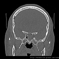 pituitary gland tumor CT cor1.jpg