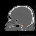 pituitary gland tumor CT sag1.jpg