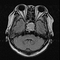 pituitary gland tumor MRI axi1.jpg