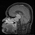 pituitary gland tumor MRI sag2.jpg