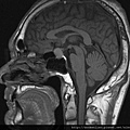 Pituitary gland tumor MRI sagittal 1.jpg