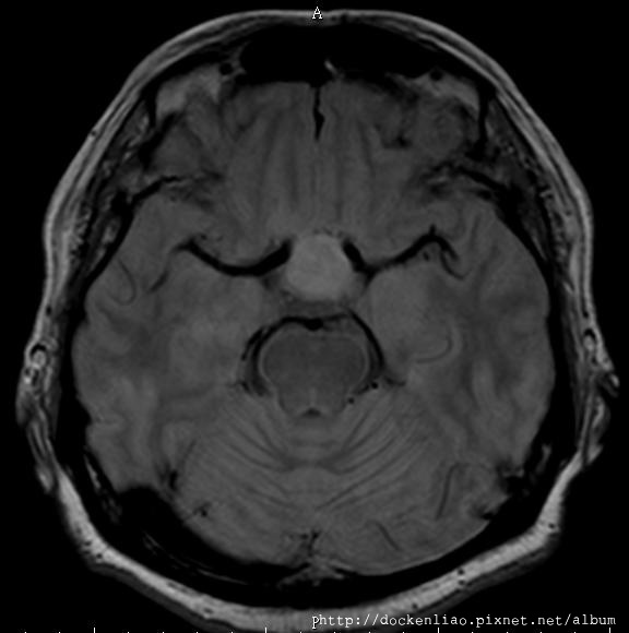MRI PITUITARY GLAND TUMOR AXIAL 2.jpg