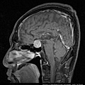 MRI PITUITARY GLAND TUMOR SAGITTAL 5.jpg