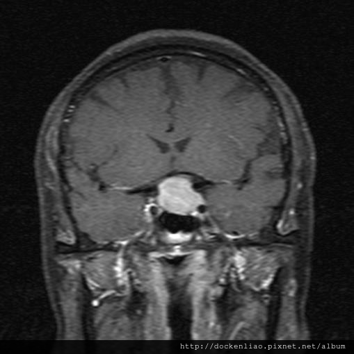 MRI PITUITARY GLAND TUMOR CORONAL 8.jpg