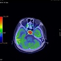 PITUITARY GLAND TUMOR PET CT AXIAL 2.jpg