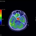 PITUITARY GLAND TUMOR PET CT AXIAL.jpg