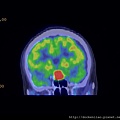 PITUITARY GLAND TUMOR PET CT CORONAL 1.jpg