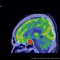 PITUITARY GLAND TUMOR PET CT SAGITTAL 2.jpg