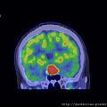 PITUITARY GLAND TUMOR PET CT CORONAL 2.jpg