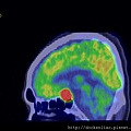 PITUITARY GLAND TUMOR PET CT SAGITTAL 1.jpg