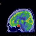 PITUITARY GLAND TUMOR PET CT SAGITTAL 3.jpg