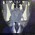 唾液腺結石 電腦斷層 sialolith CT scan