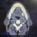 唾液腺結石 電腦斷層 sialolith CT scan 2