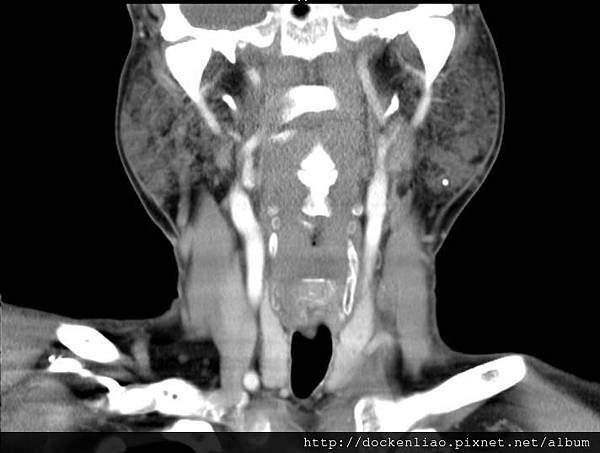 parotid tumor calcification CT cor2.jpg