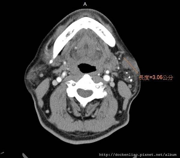parotid tumor calcification CT axi1.jpg