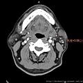 parotid tumor calcification CT axi1.jpg