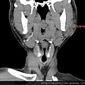 parotid tumor calcification CT cor1.jpg