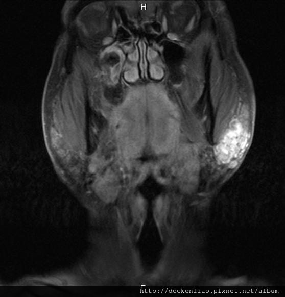 parotid tumor MRI cor2.jpg