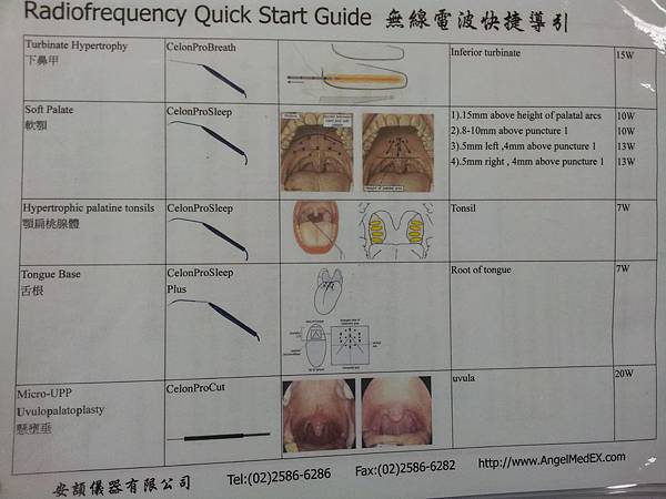 簡易的內視鏡打鼾手術：無線電波(RF)，縮小上顎與舌頭的體積