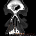 鼻翼囊腫 nasoalveolar cyst