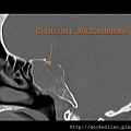 Pituitary macroadenoma CT sag 2.jpg