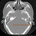 Pituitary macroadenoma CT axi2.jpg