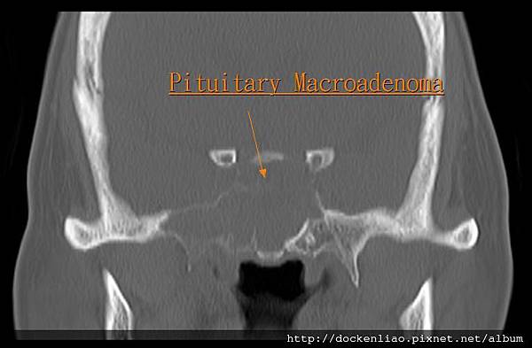 Pituitary macroadenoma CT cor1.jpg