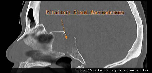 Pituitary macroadenoma CT sag 1.jpg
