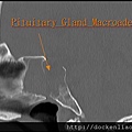 Pituitary macroadenoma CT sag 1.jpg