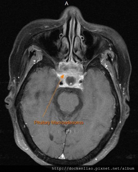 Pituitary macroadenoma MRI axi1.jpg