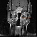 Pituitary macroadenoma MRI cor1.jpg