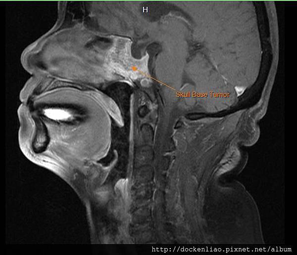 Pituitary macroadenoma MRI sag 2.jpg