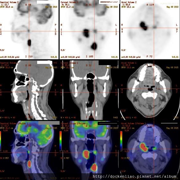 扁桃腺癌與下咽癌 left hypopharyngeal cancer %26; right tonsil cancer PET CT