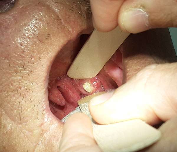 常見的扁桃腺結石與化膿 導致經常性的喉嚨發炎疼痛 奇譽 廖倩茹 林沁梅 林彩勤 與 劉耿僚 的醫療中心 痞客邦 常見的扁桃腺結石與化膿 導致經常性的喉嚨發炎疼痛 奇譽 廖倩茹 林沁梅 林彩勤 與 劉耿僚 的醫療中心 痞客邦