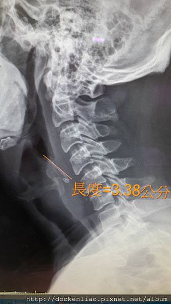 V字型的食道異物(雞骨頭) esophageal foreign body chicken bone