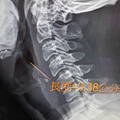 V字型的食道異物(雞骨頭) esophageal foreign body chicken bone