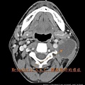 頸部轉移癌 neck metastatic cancer CT axi