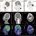 頸部轉移癌 neck metastatic cancer PET CT