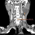 頸部轉移癌 neck metastatic cancer CT cor